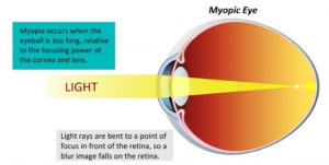 myopia1