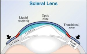 scleral lens